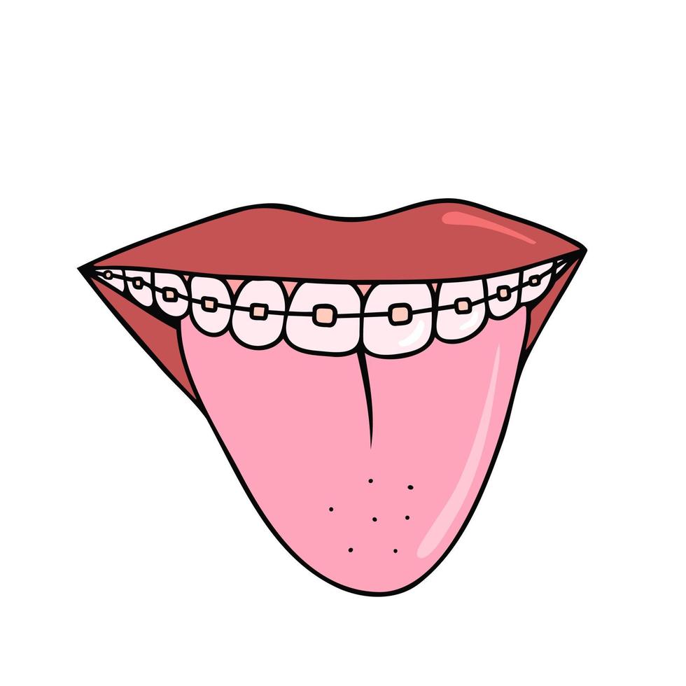 Mouth with tongue, braces. Illustration for printing, backgrounds, covers and packaging. Image can be used for greeting cards, posters, stickers and textile. Isolated on white background. vector
