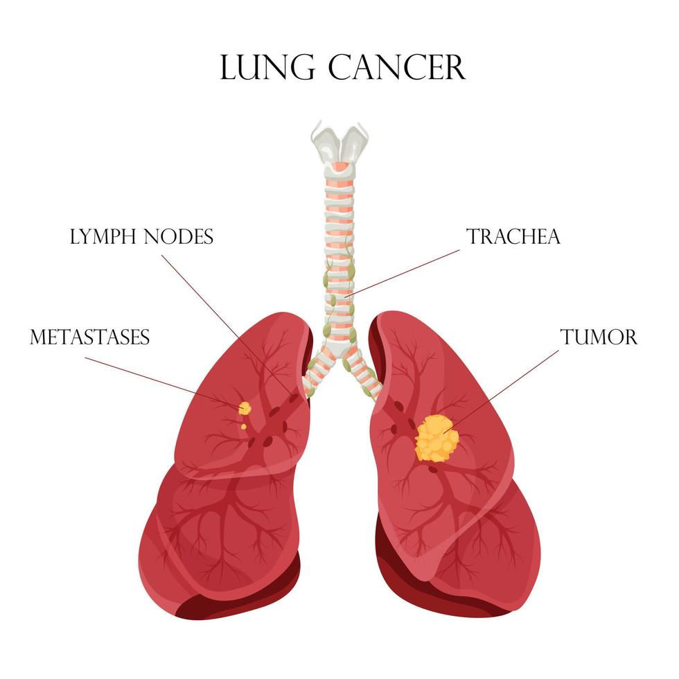 diagrama de enfermedad de cáncer de pulmón. concepto enfermedad órganos internos humanos. ilustración vectorial, estilo de dibujos animados. vector