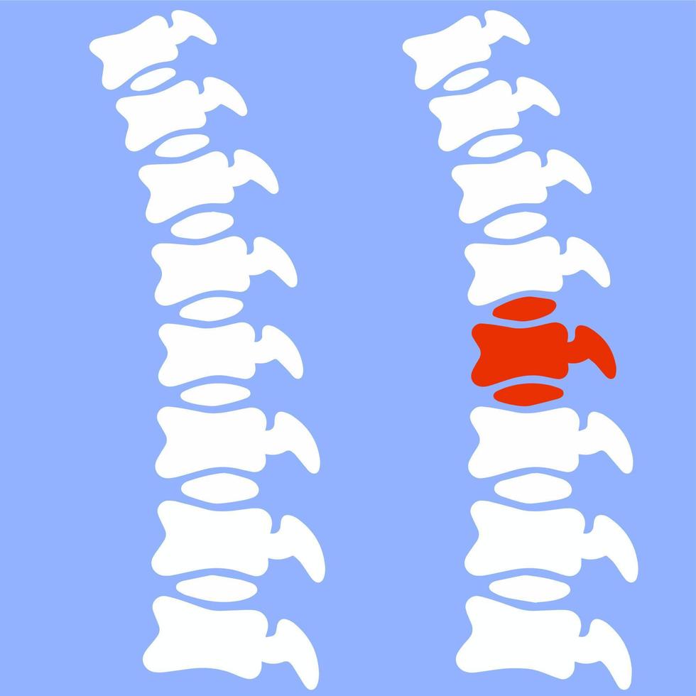 Problems with the spine. Crack in intervertebral disc. Pain and trauma. Medical care. Vertebra x-ray. Cartoon flat illustration. Poor posture on blue background. White human bones. Sore place in back vector