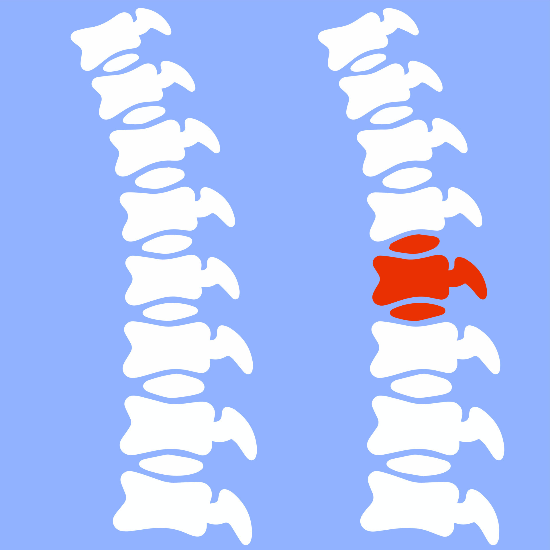 Problems with the spine. Crack in intervertebral disc. Pain and trauma