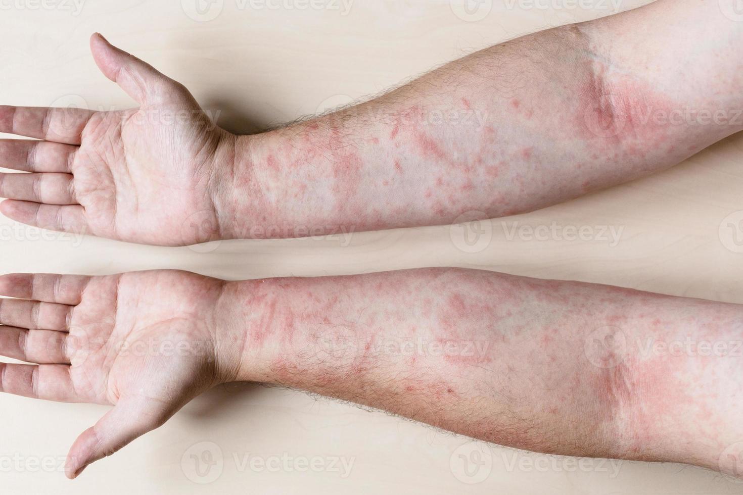 male arms with inflamed skin photo