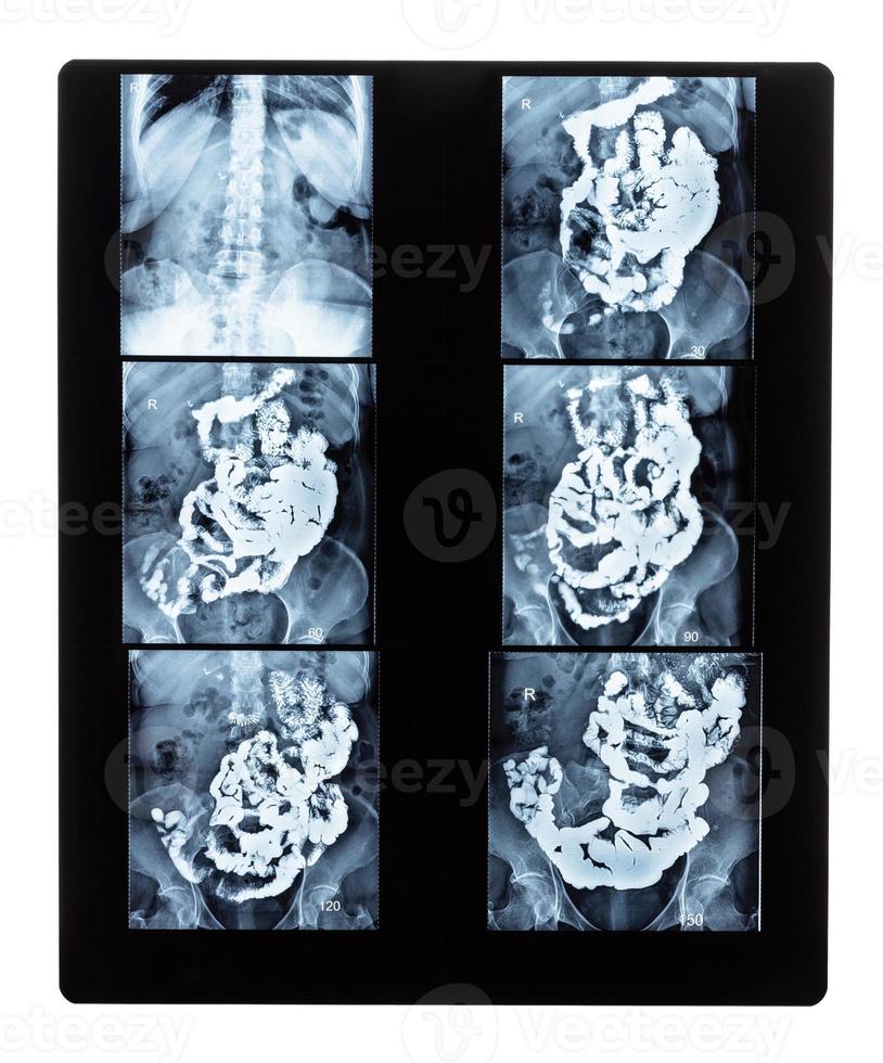 set of X-ray with Barium studies of small bowel photo