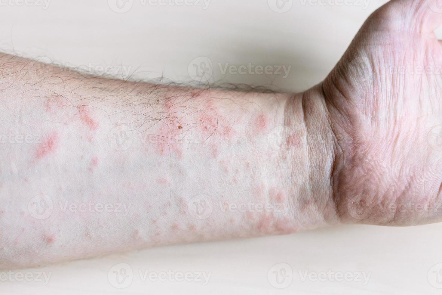 ink rash on inner side of forearm close up photo