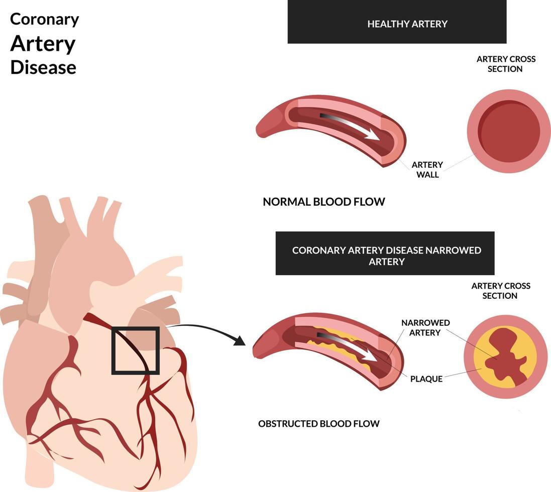 illustration of heart with coronary artery disease showing normal blood flow and obstructed blood flow vector