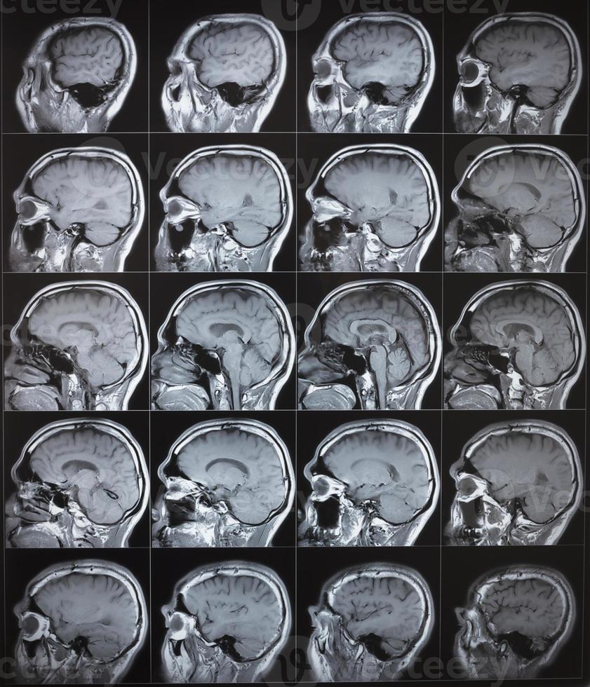 Side view of human normal brain MRI photo