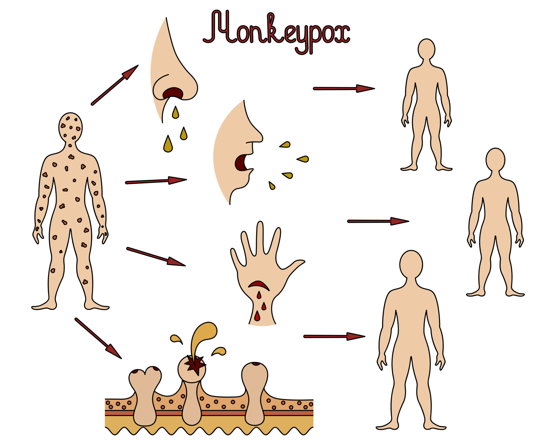 The mechanism of transmission of monkeypox. Diagram of human-to-human  transmission of the smallpox virus. Color vector illustration. Transmission  through body fluids, skin injury. Viral disease. 11262786 Vector Art at  Vecteezy