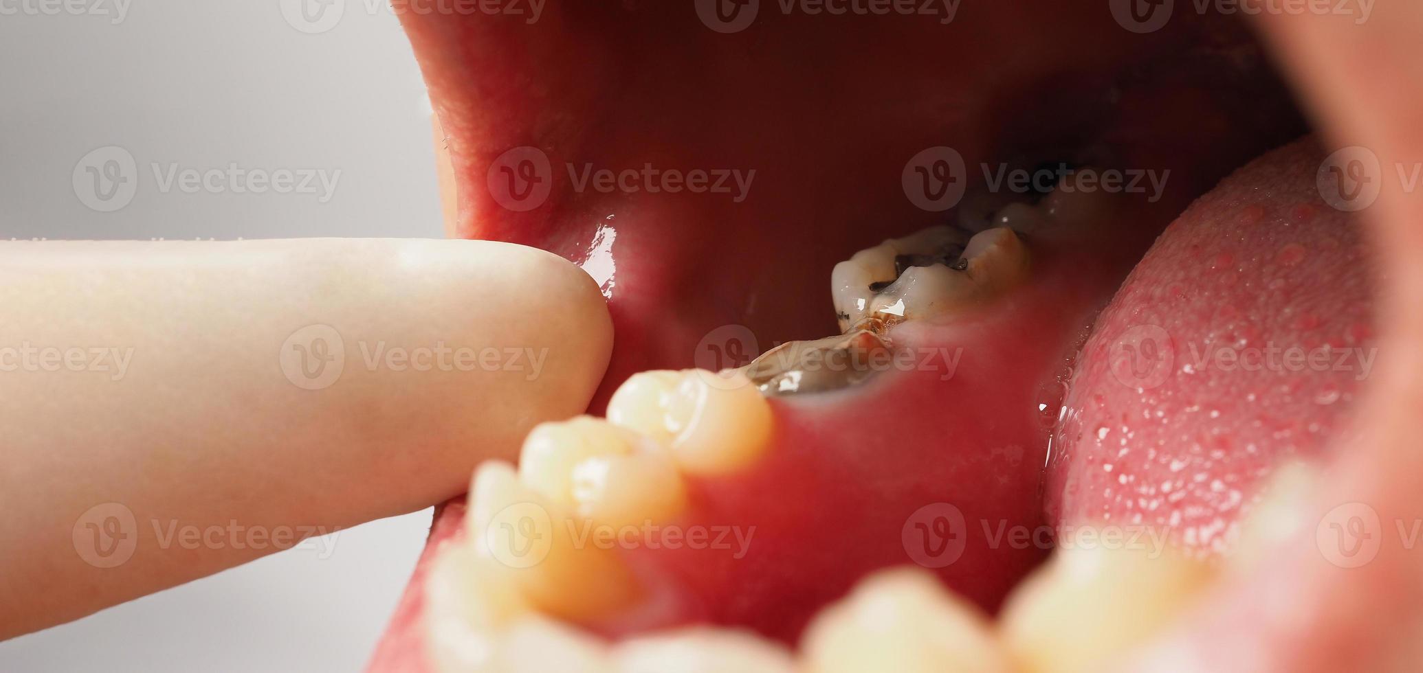 Tratamiento de conductos radiculares de dientes cariados. Diente o caries dental del molar inferior. foto