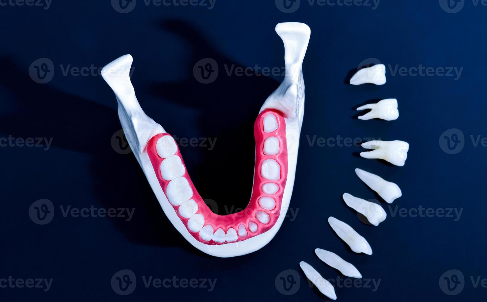 proceso de instalación de implantes dentales y coronas foto