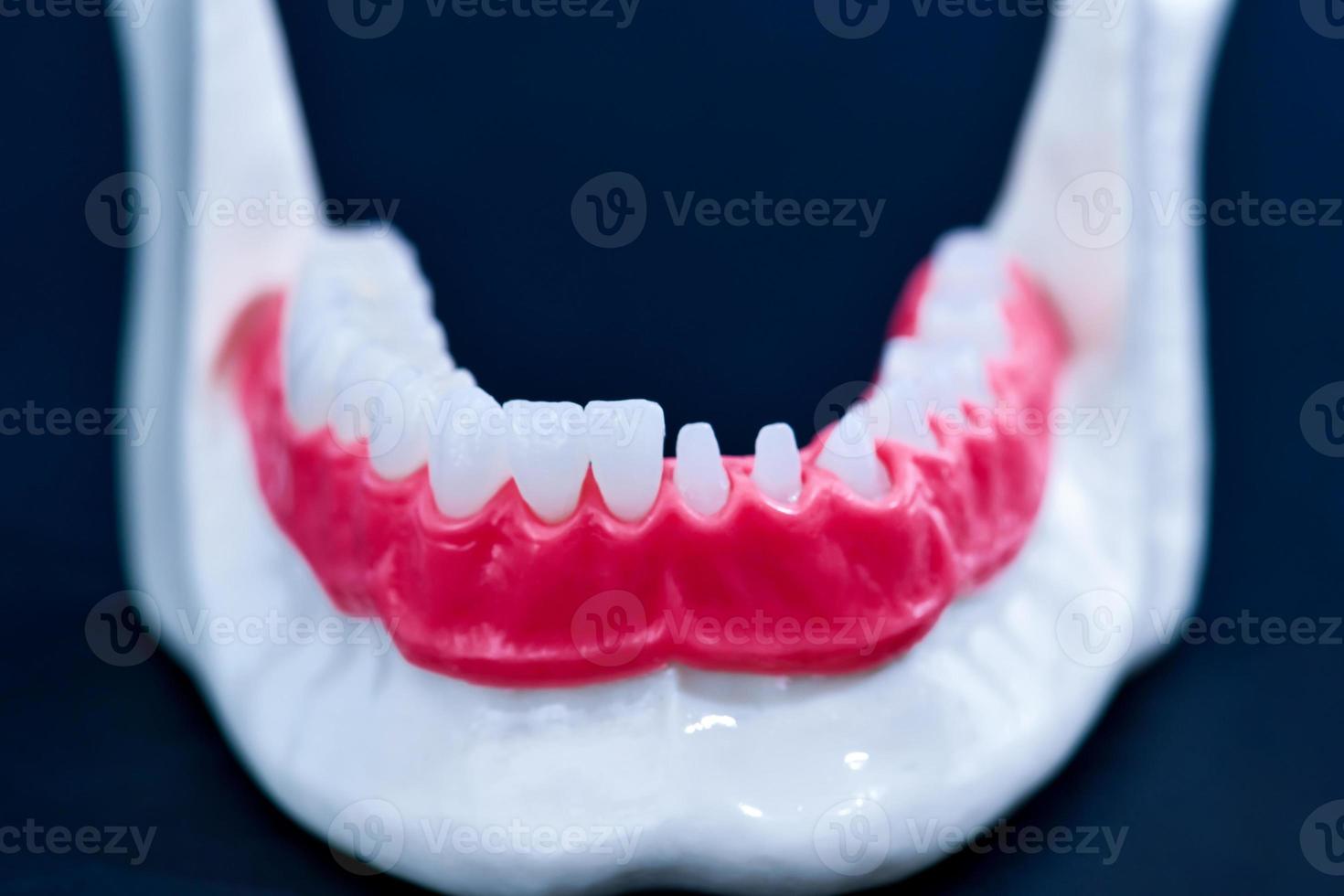 Tooth implant and crown installation process photo