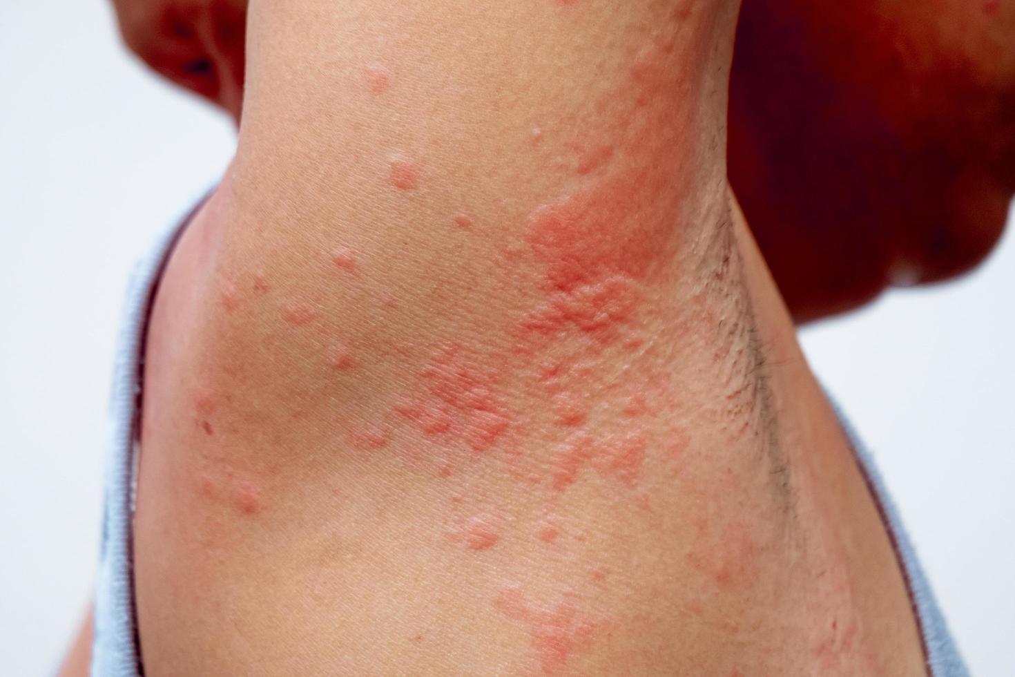 Erupción alérgica del problema de la dermatitis. problema de la piel por alergia a los medicamentos. foto