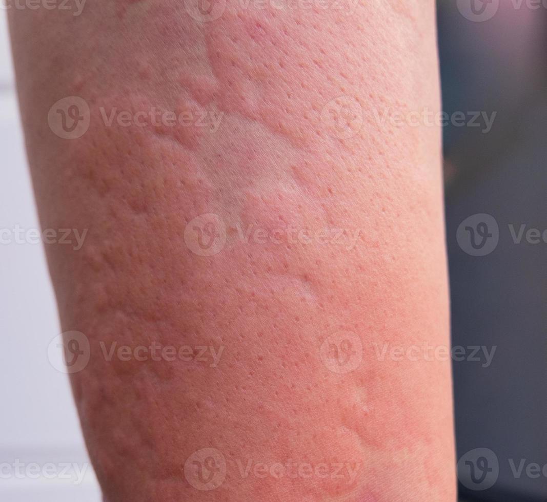 Strong allergic rashes on the body Impaired immunity and reaction to allergenic products. Dermatological rash on the skin and body The problem of health and cosmetology. Immune System Disease, Allergy photo