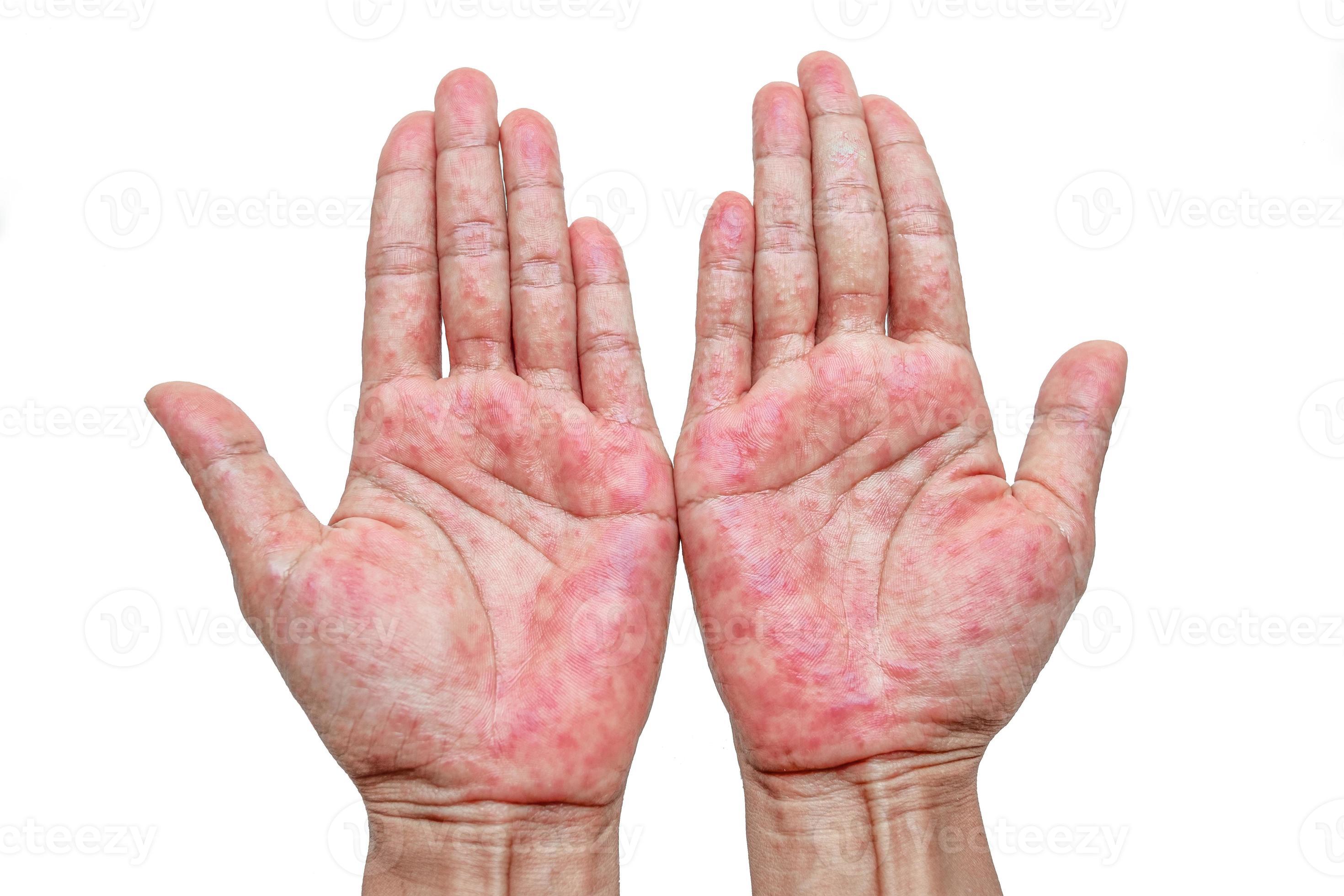 Hands rash. Red sports on the hand, and fingers. Photo at Vecteezy