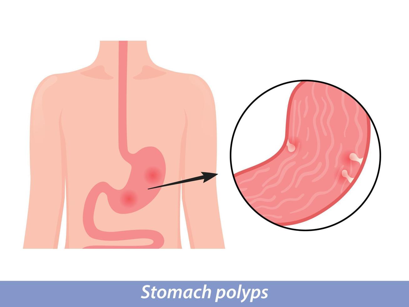 Diagnóstico y extirpación de pólipos estomacales. concepto de procedimiento de endoscopia vector