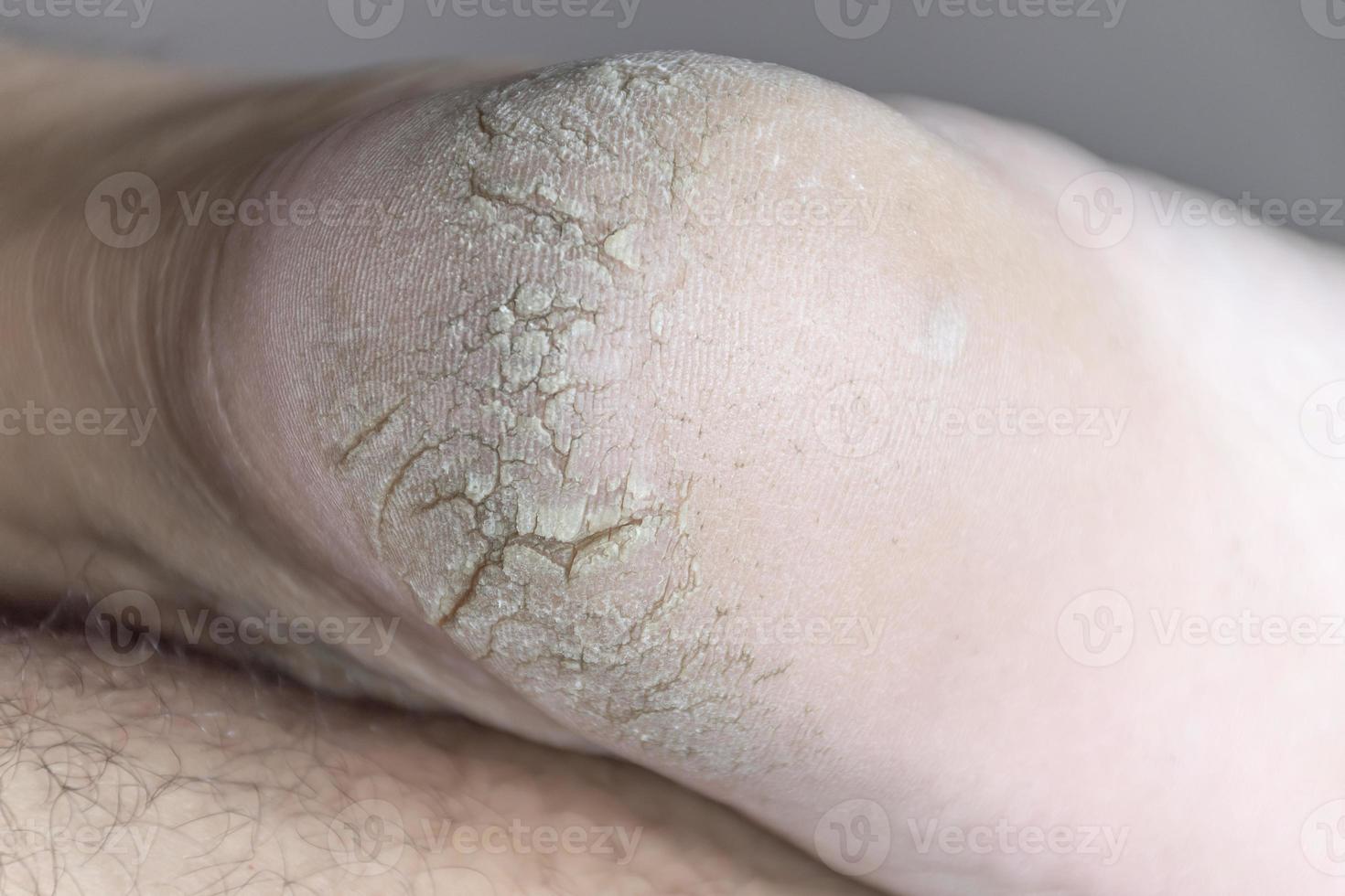 Close up cracked heel further deep cracks and dry flaky skin photo