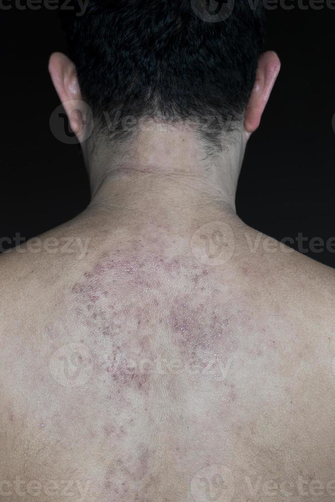 Texture red rash on back man photo