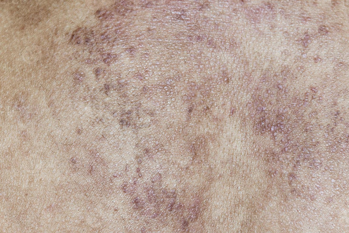 Texture red rash on back man photo