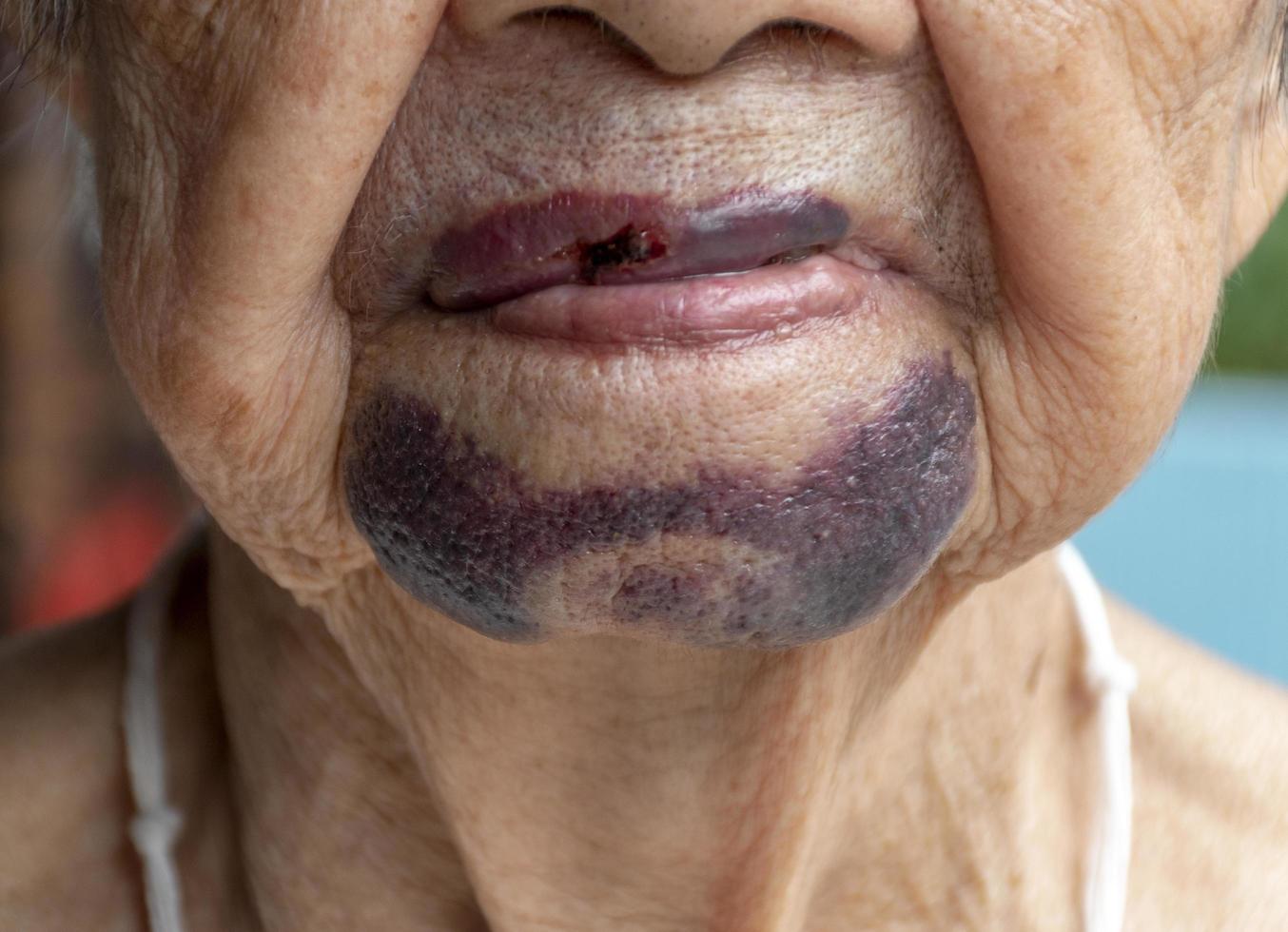 Close up chin senior woman has bruises photo