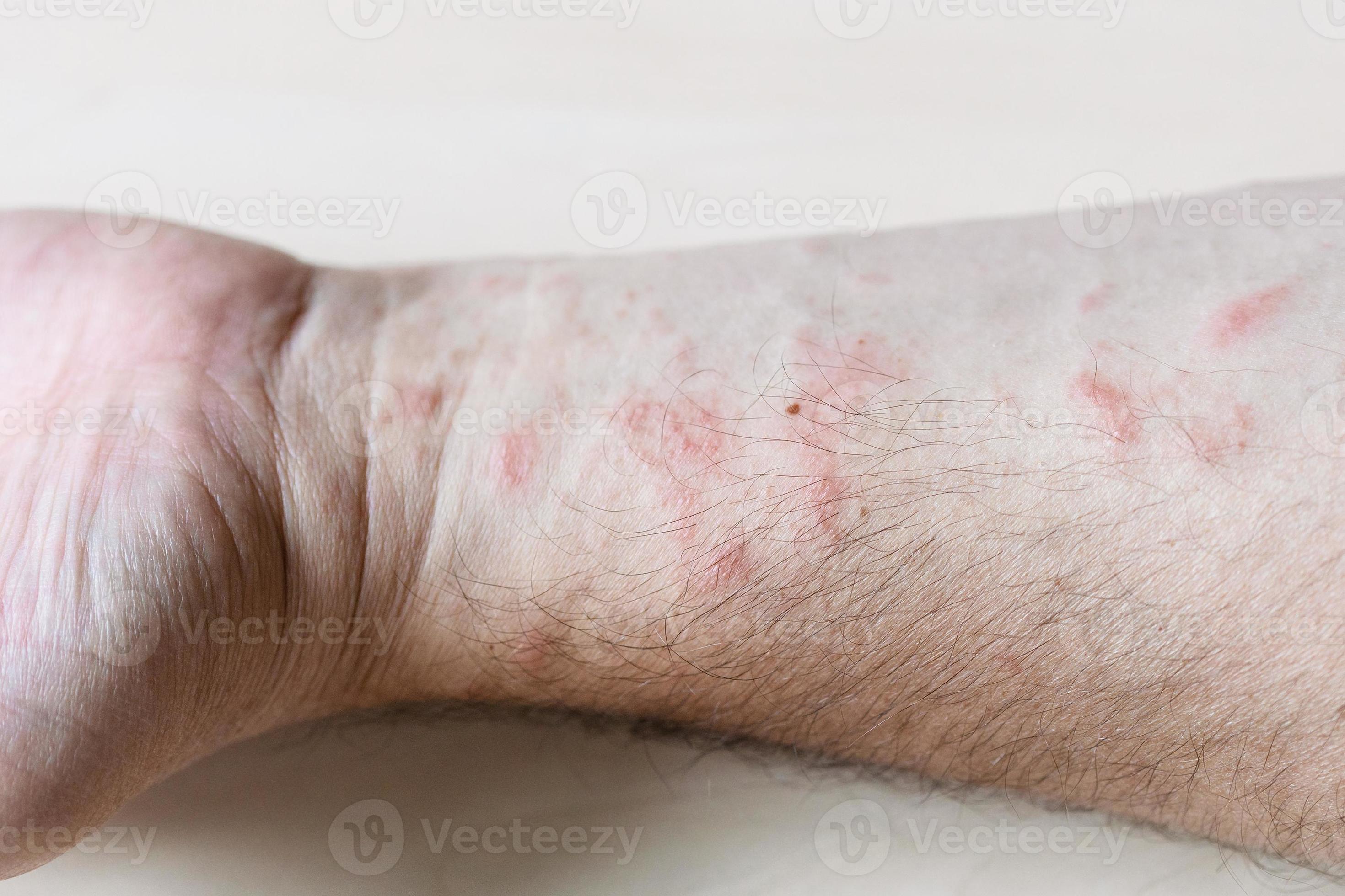 rash on inner side of forearm close up 11386092 Stock Photo at Vecteezy