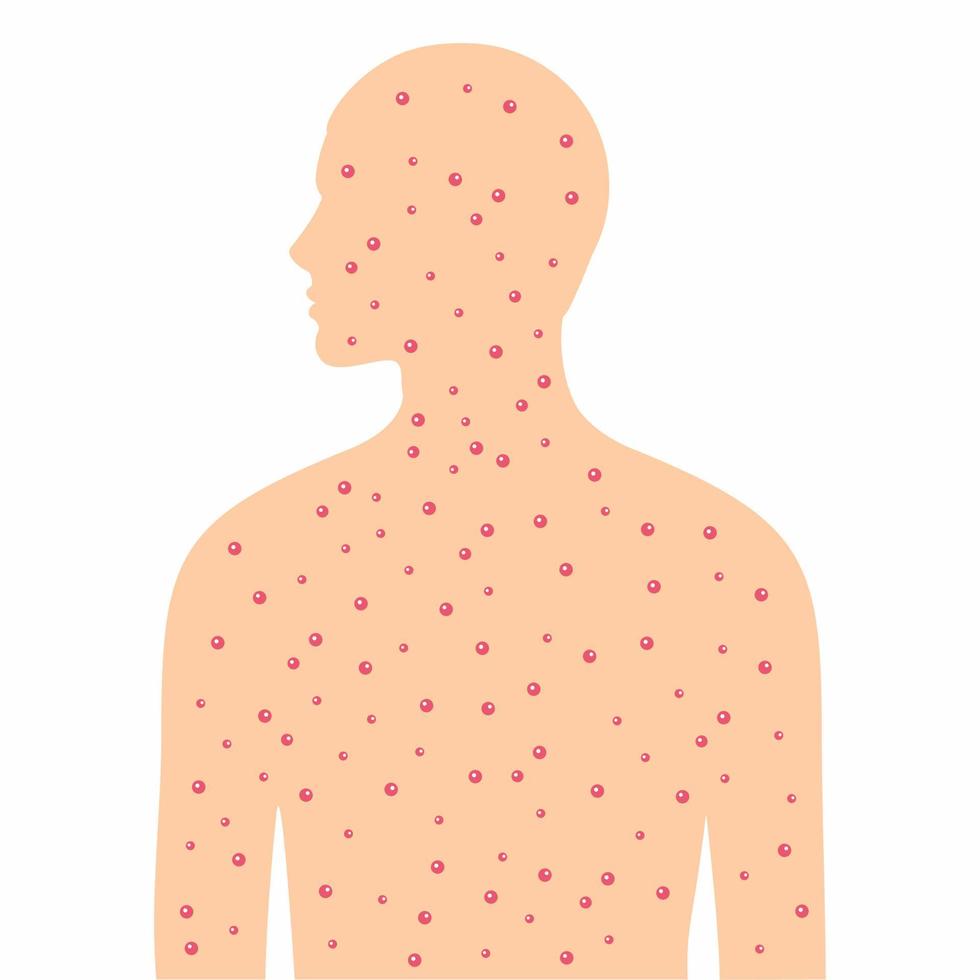 The human body covered with pimples vector