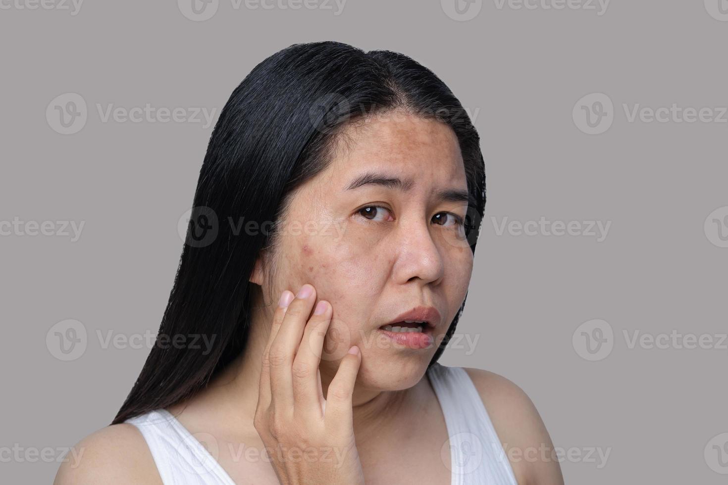 Asian adult woman's face has freckles, large pores, blackhead pimples and scars problem from not take care for a long time. Skin problem face isolated white background. Treatment and Skincare concept photo
