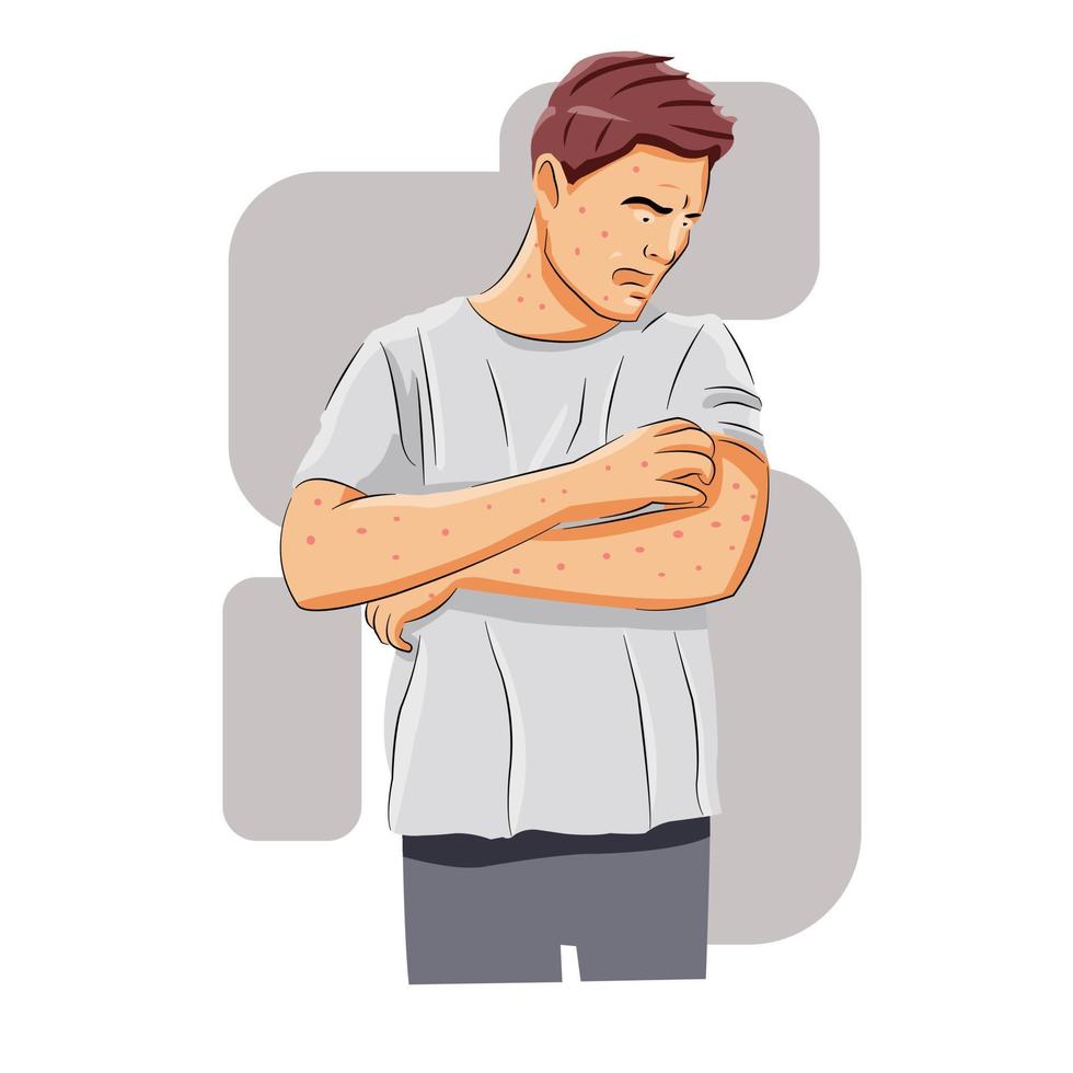 Man having chicken pox disease vector