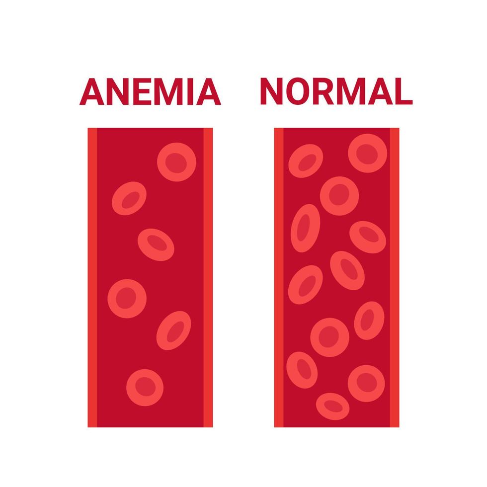Normal and anemia blood in vessel comparison, number circulation cells