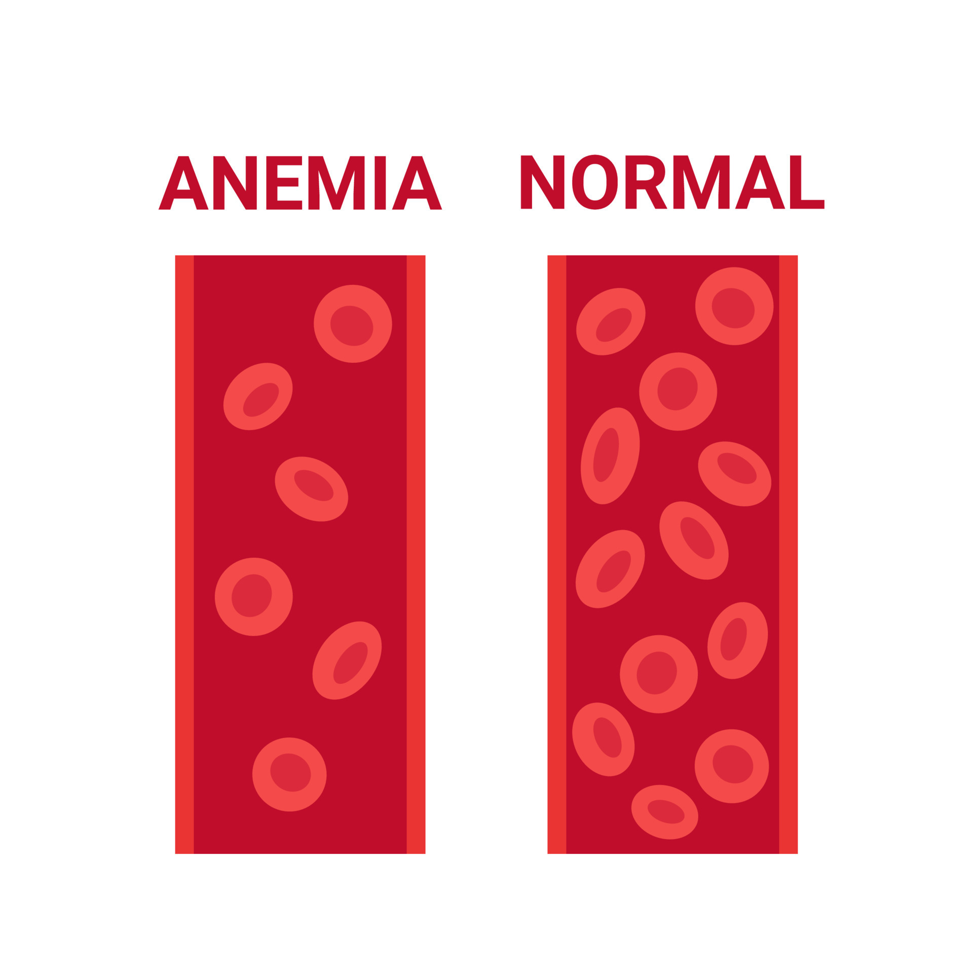 Normal and anemia blood in vessel comparison, number circulation cells