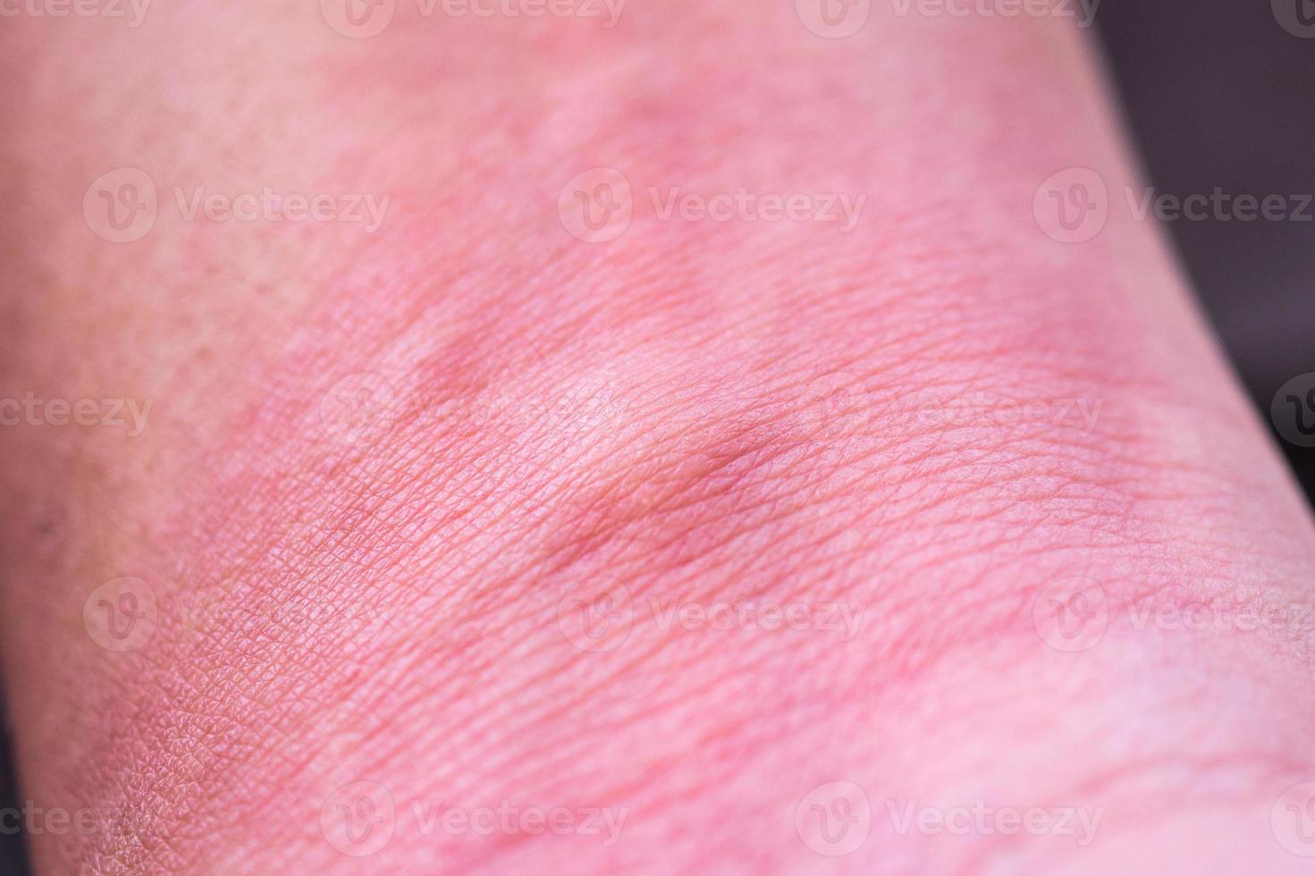 skin allergy with rash after mosquito bite photo
