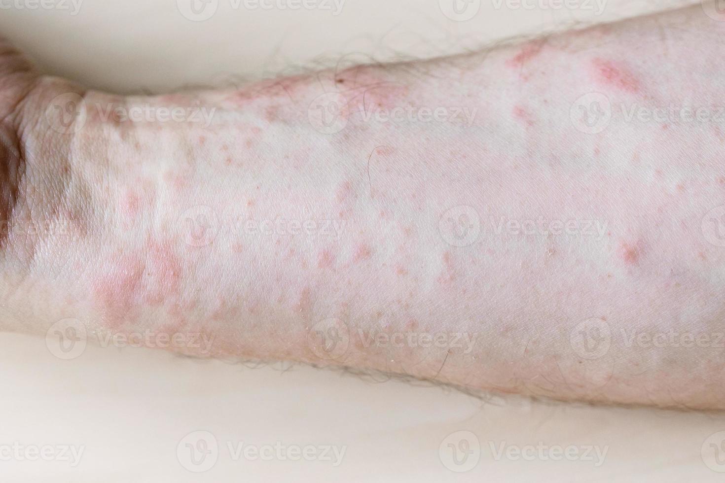 papules on inner side of forearm close up photo