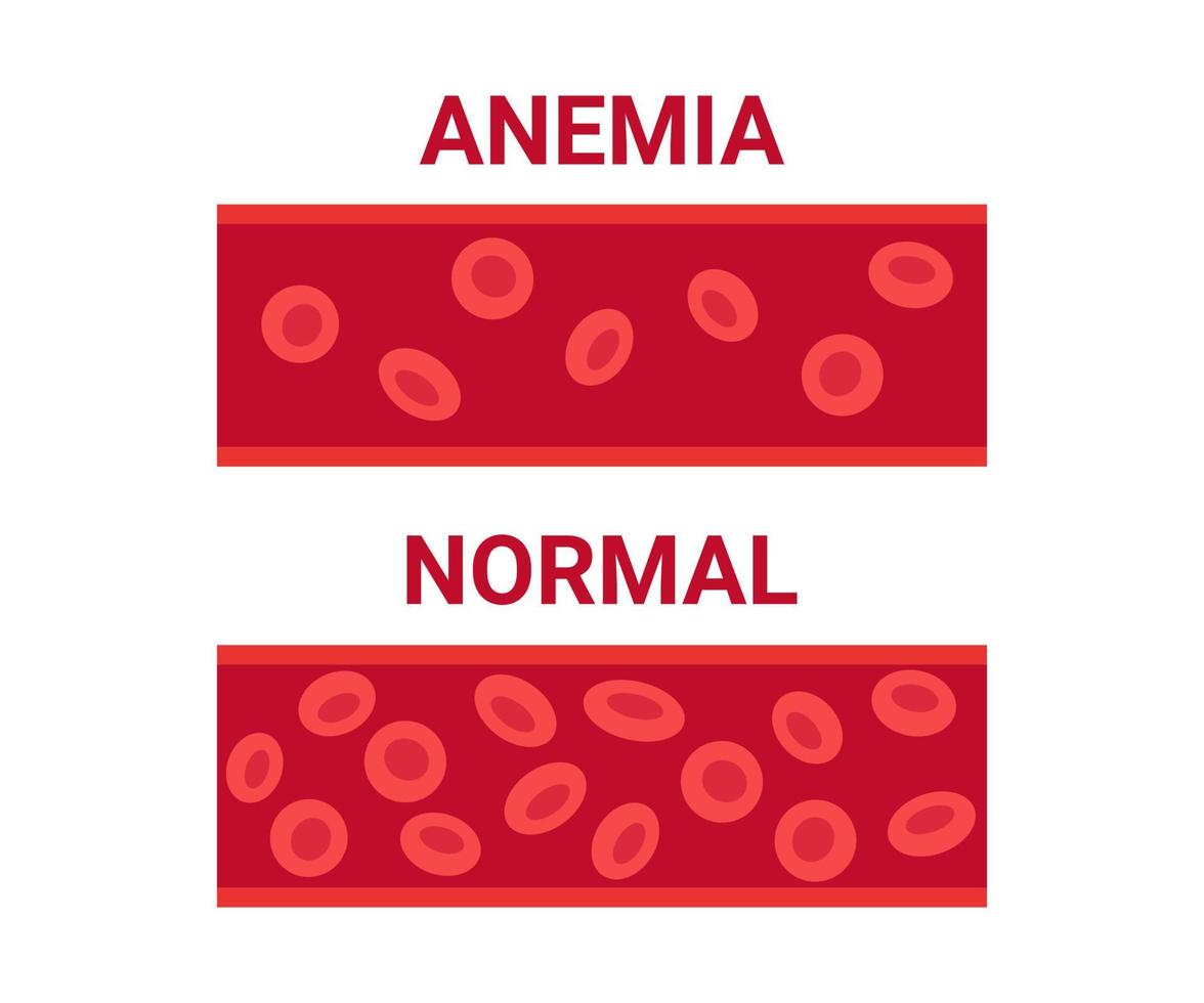 Normal and anemia blood in vessel comparison, number circulation cells erythrocyte. Hemoglobin low level, iron deficiency anemia. Disease anemic blood cells. Health problem. Vector illustration