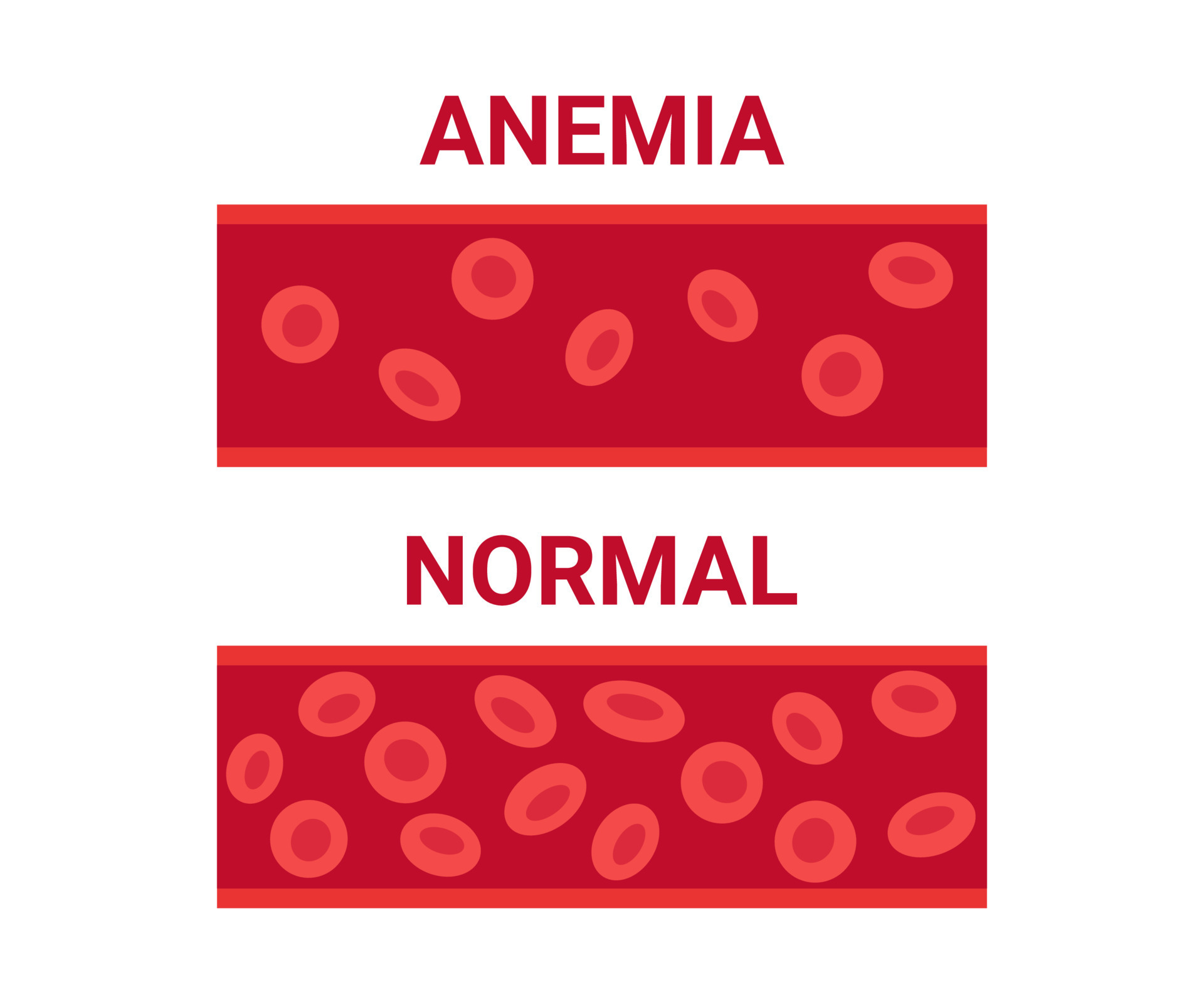 Normal and anemia blood in vessel comparison, number circulation cells