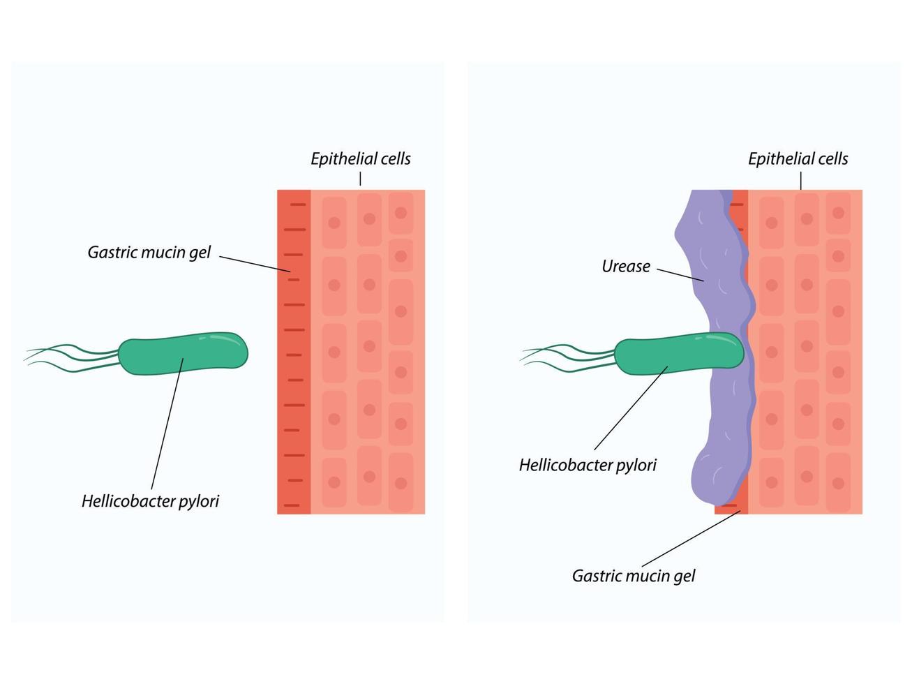 invasión de helicobacter pylori en los tejidos del estómago vector