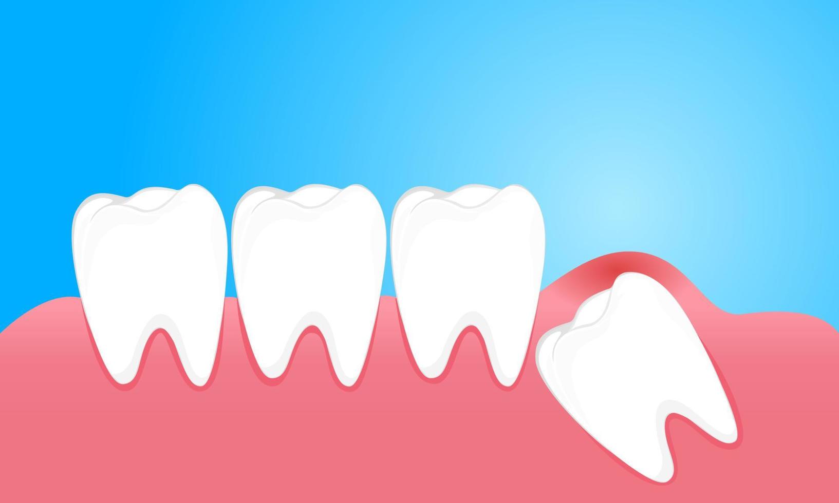 Wisdom teeth cause pain to the gums vector