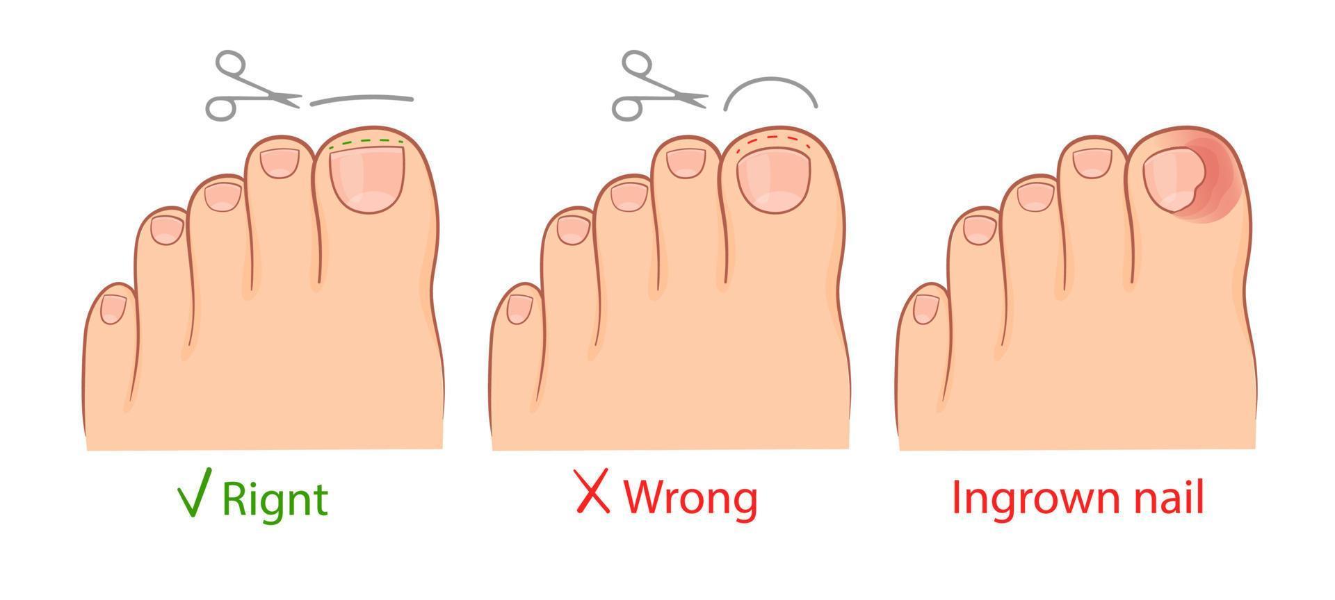 correction of an ingrown toenail with titanium thread. medical illustration vector