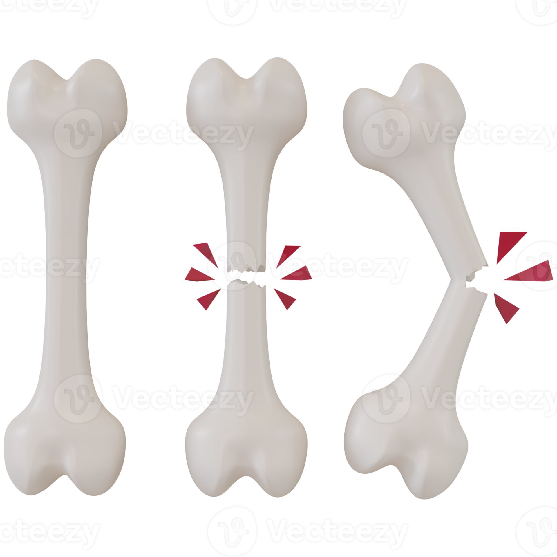 3d rendering of broken bones in different stages 11659442 PNG