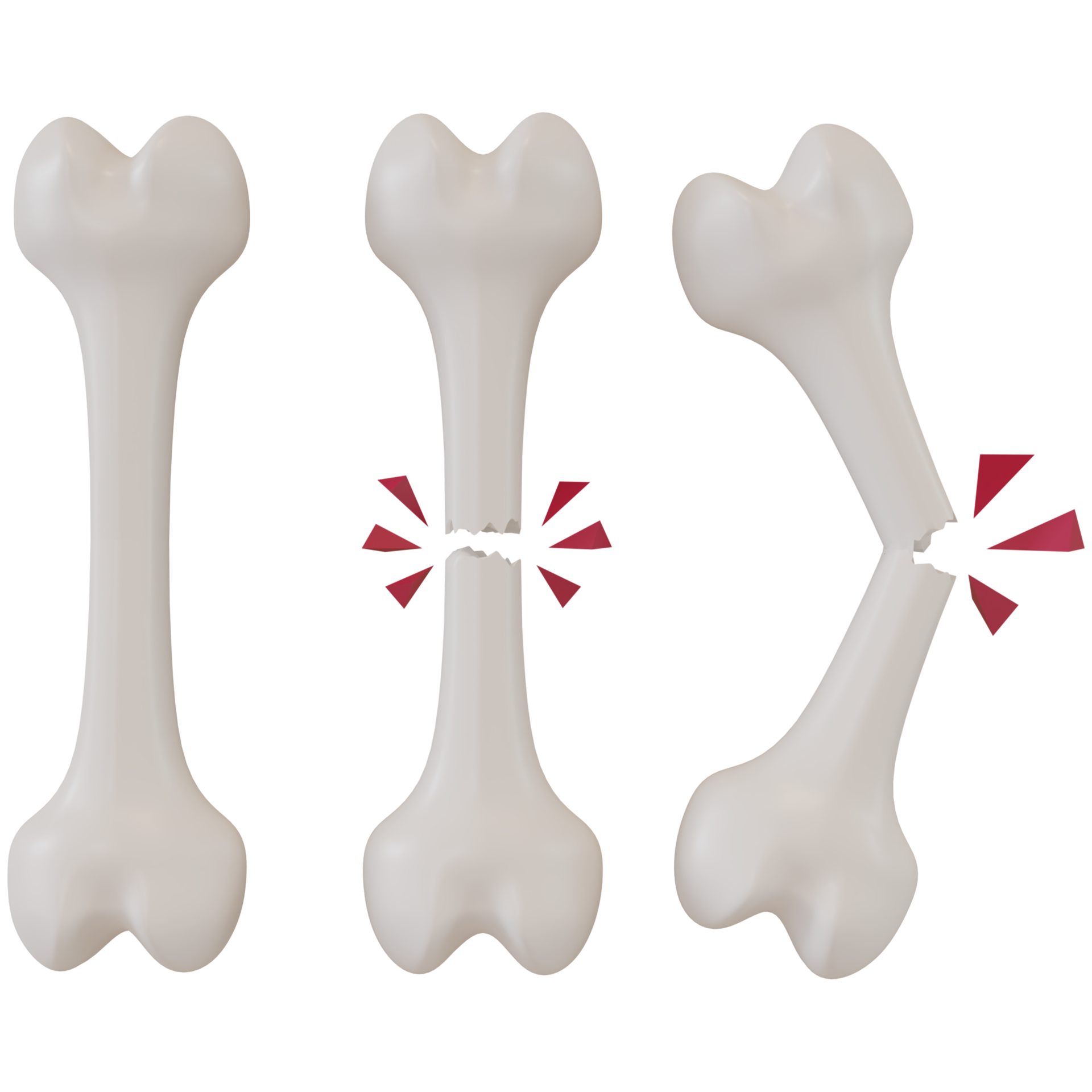 3d rendering of broken bones in different stages 11659442 PNG
