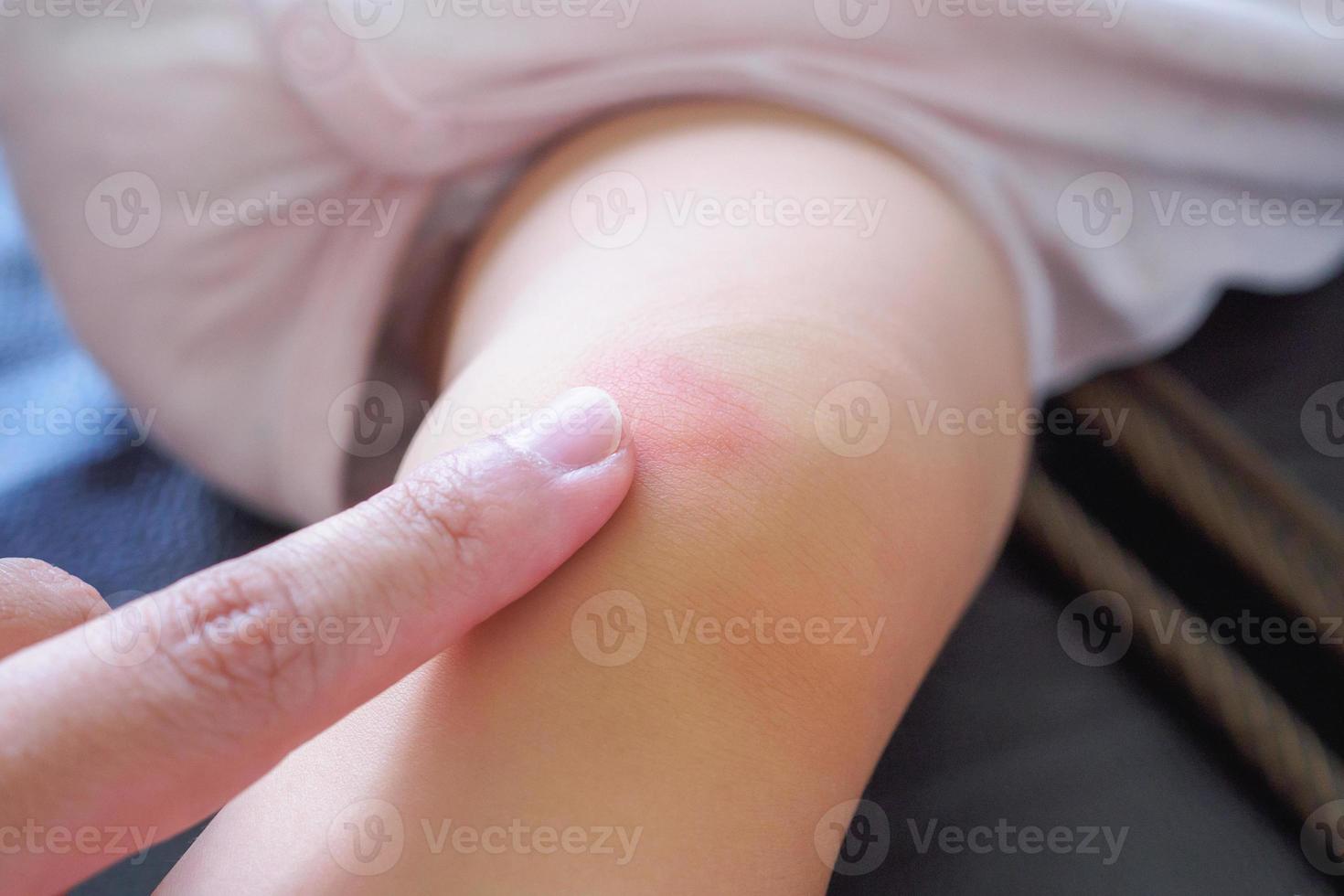 mother apply antiallergic cream at baby knee with skin rash and allergy with red spot cause by mosquito bite photo