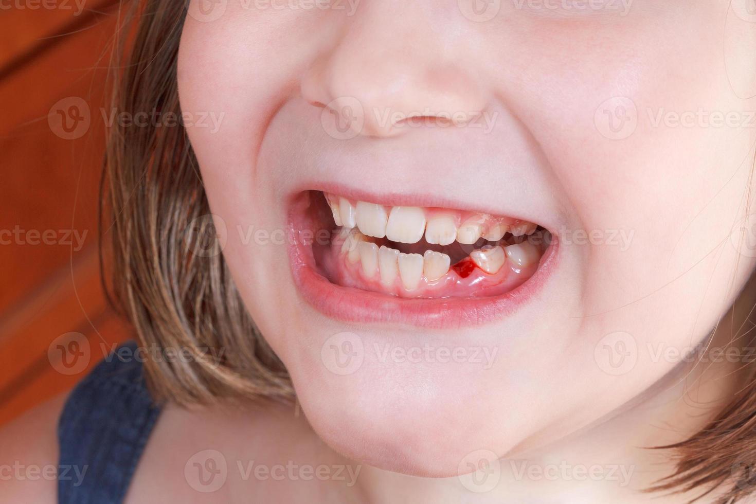 fallen baby tooth in girl mouth photo