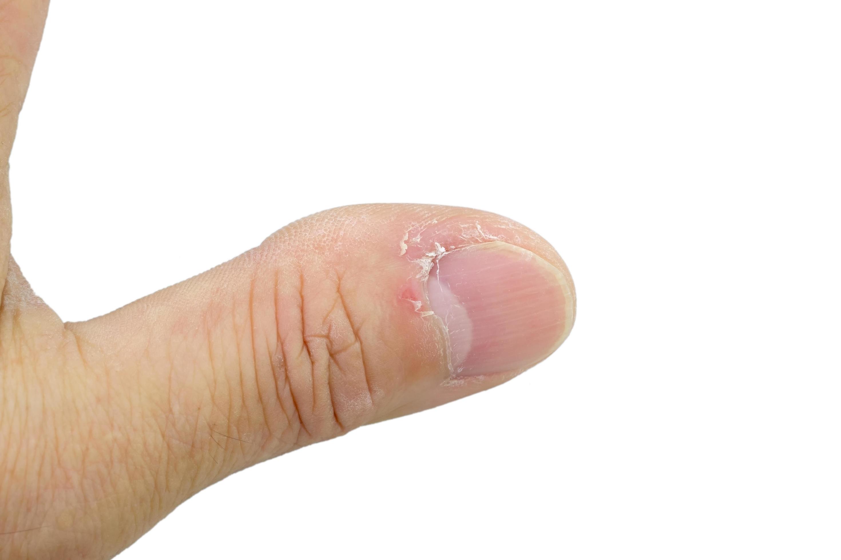 Closeup of thumb and nail with dry skin, torn and flaking off, cracked