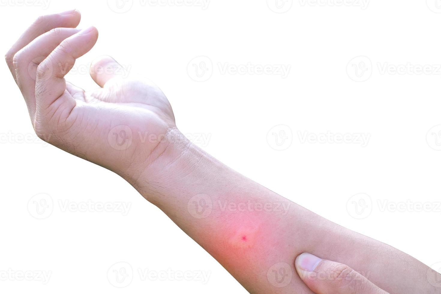 Swollen arms due to mosquito bites isolate on white background with clipping path, poisonous animals, plague in the rainy season photo