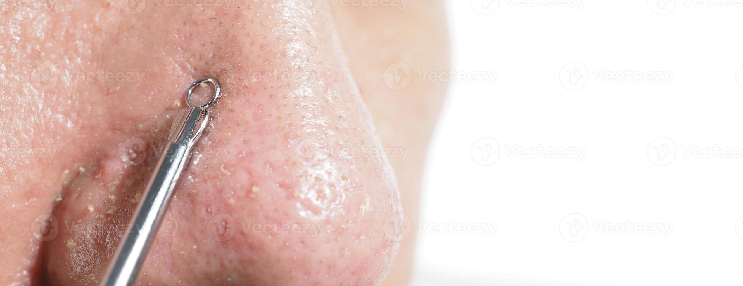 Acne and problem pores. White and blackhead pimples from nose pores. photo