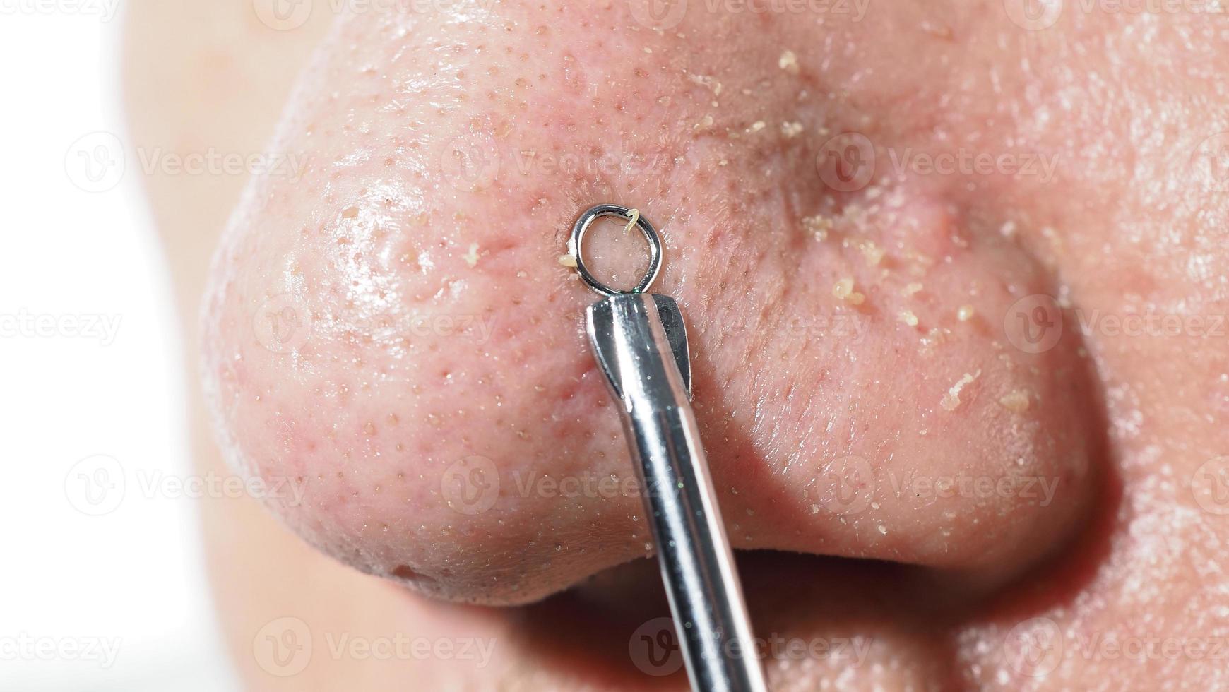 Acne and problem pores. White and blackhead pimples from nose pores. photo