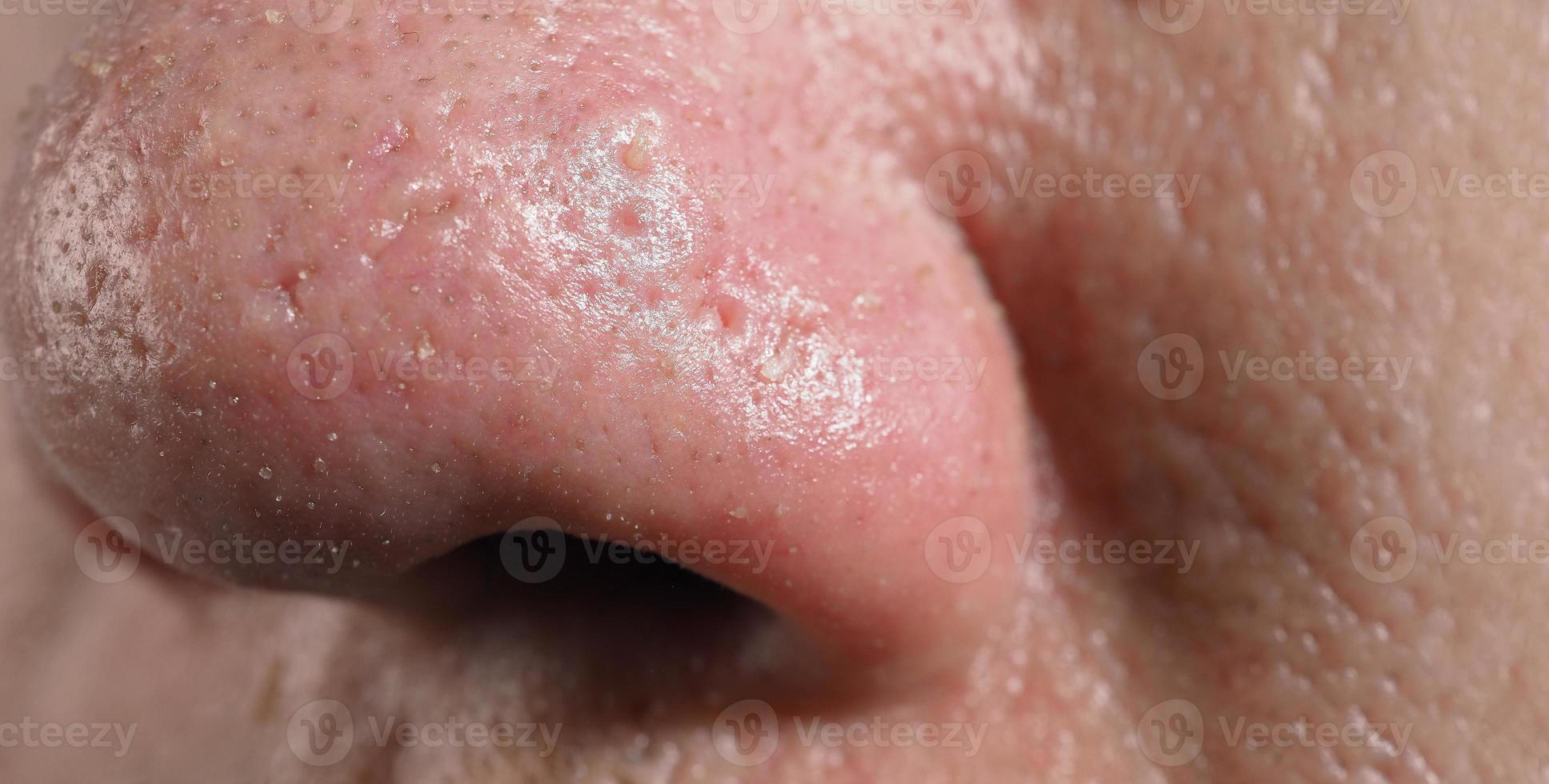 Acne and problem pores. White and blackhead pimples from nose pores. photo