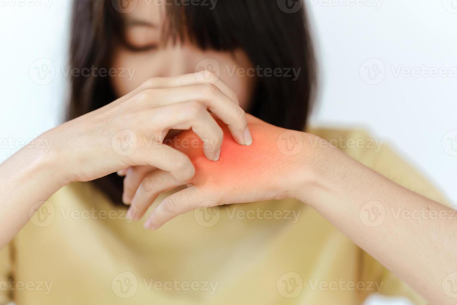 la mano de una mujer se rasca la mano debido a una reacción alérgica o una enfermedad de la piel. foto