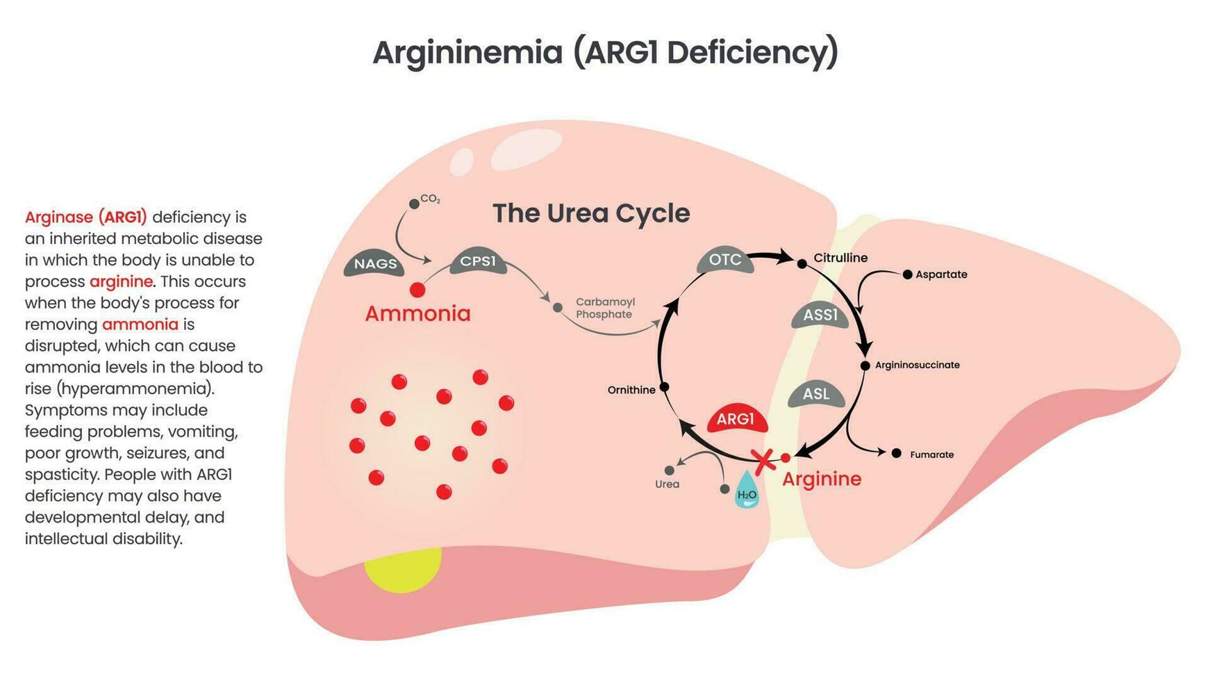 Ilustración de diagrama vectorial de deficiencia de arginasa arg1 vector