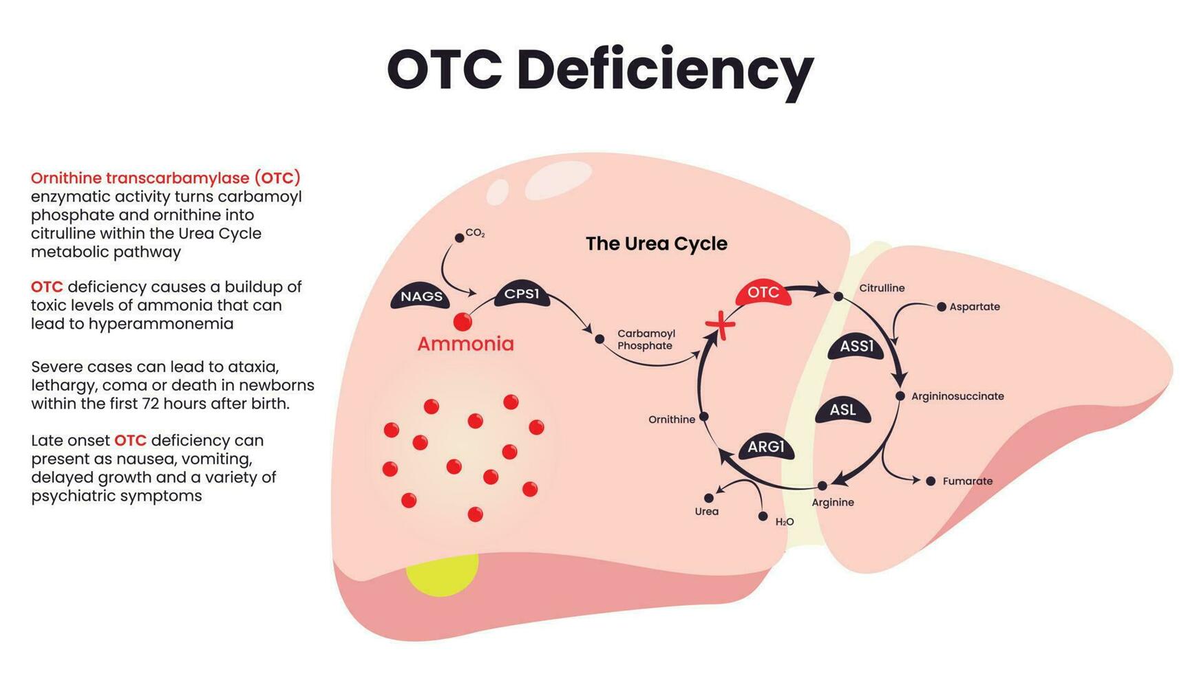 vector de diagrama de deficiencia de ornitina transcarbamilasa otc