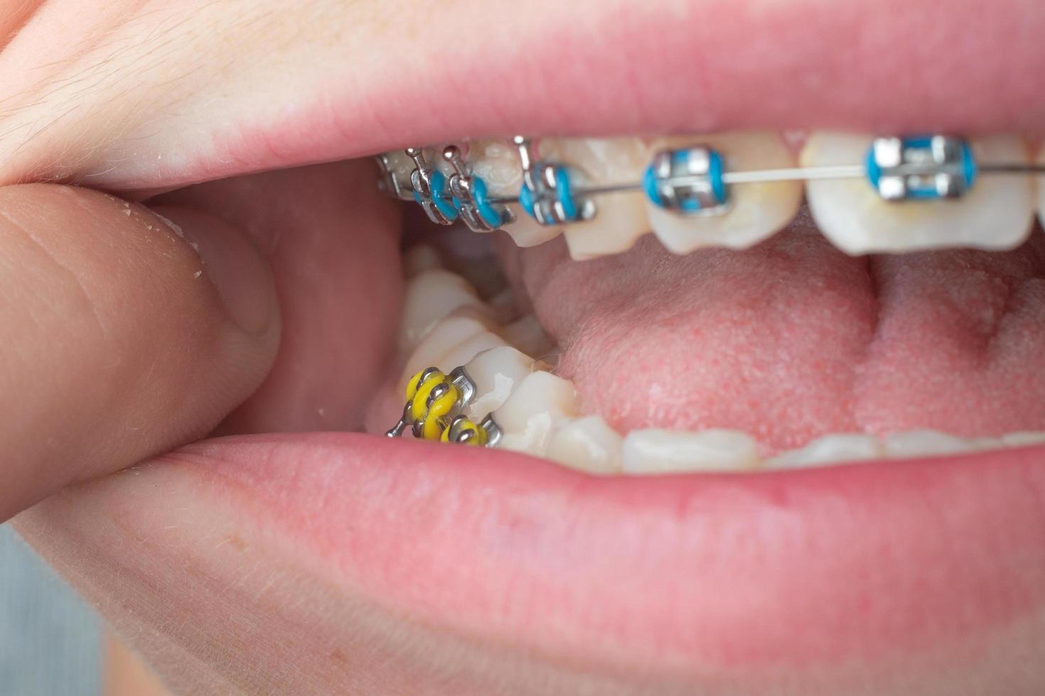 Braces with blue and yellow rubber bands close-up. photo
