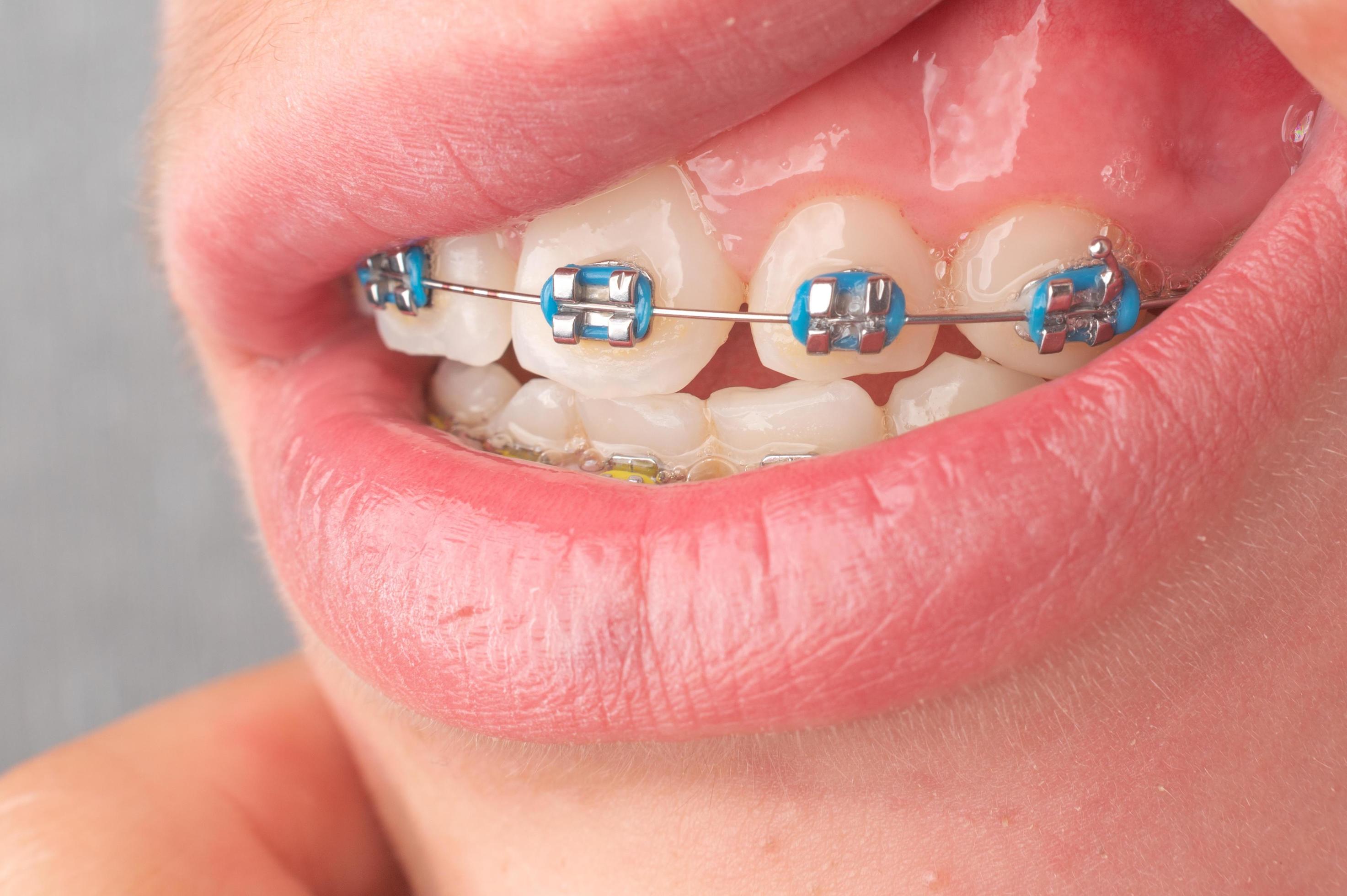 Braces with blue and yellow rubber bands closeup. 11771240 Stock Photo