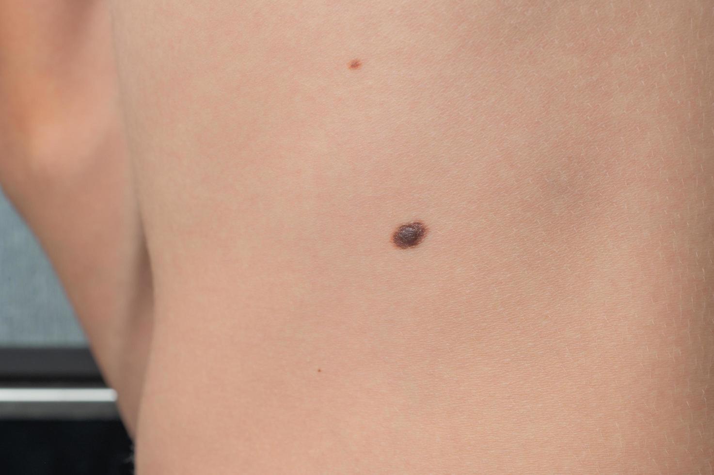 Brown warts on the child's body. photo