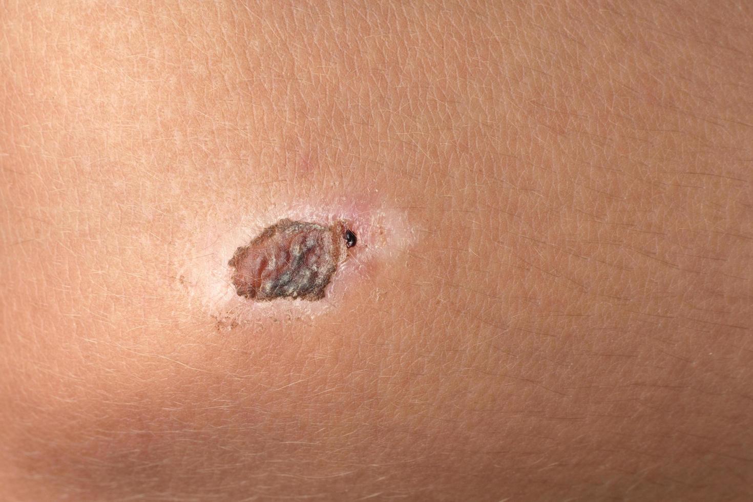The wound on the child's leg has already healed. photo